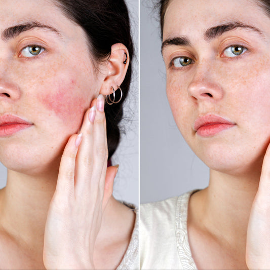 Rosacea