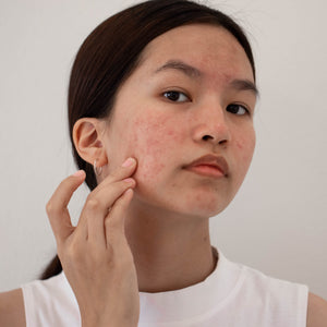 Acne Oily Full Size Kit