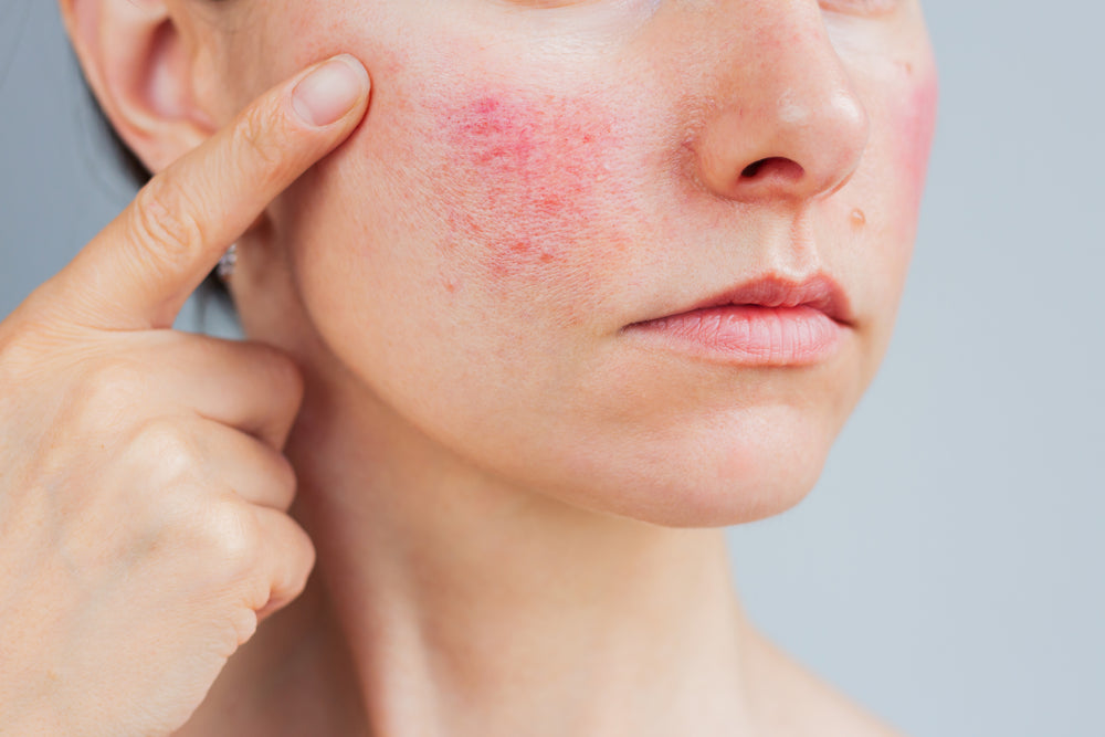 Rosacea Travel Kit